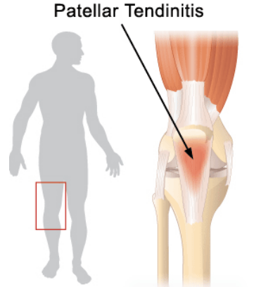 bon secours hampton roads patellar tendinitis